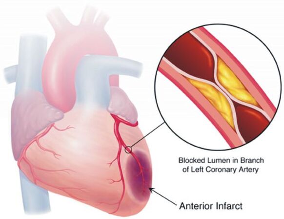 One of the complications of hypertension is coronary heart disease.